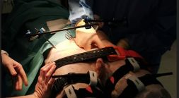 Pelvic Packing Sub-carrier Base